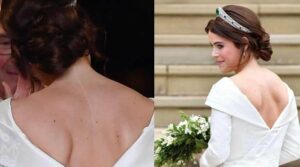 Princess Eugenie living with a scar for years